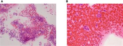 Case Report: Papillary thyroid carcinoma in Goltz–Gorlin syndrome